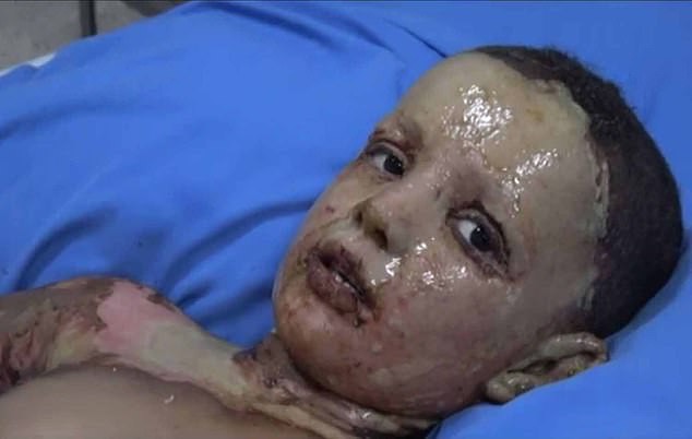 Dư luận quốc tế chấn động trước một loạt hình ảnh trẻ em Syria với những vết bỏng nặng, khoét sâu vào cơ thể do vũ khí hóa học gây ra - Ảnh 4.