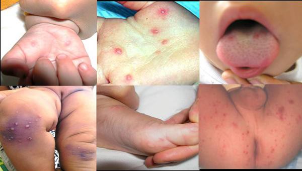 Bệnh tay chân miệng là một trong những dịch bệnh rất hay gặp ở trẻ em - Ảnh 3.
