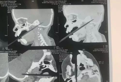 Tai nạn kinh khủng: Cha mẹ rời mắt trong thoáng chốc, bé 1 tuổi ngã khiến chiếc đũa trên tay xuyên qua vòm miệng chạm tới não  - Ảnh 2.