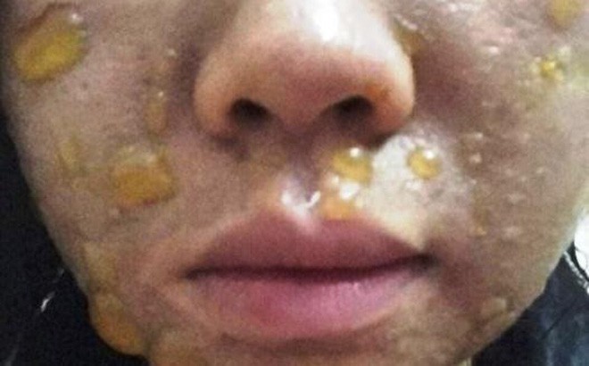 Tự &yacute; lột da mặt để mong sở hữu l&agrave;n da đẹp theo những c&aacute;ch n&agrave;y, chị em đau khổ khi mặt bỗng "h&oacute;a quỷ" - Ảnh 7.