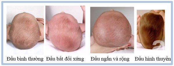 Hội chứng đầu phẳng ở trẻ sơ sinh v&agrave; những c&aacute;ch ph&ograve;ng ngừa tưởng kh&ocirc;ng dễ m&agrave; h&oacute;a ra l&agrave; dễ kh&ocirc;ng tưởng - Ảnh 2.