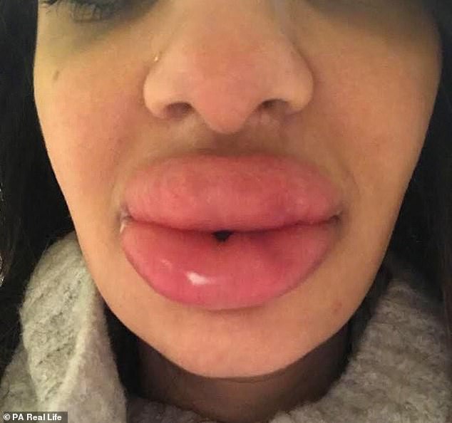 Mất gần 9 triệu bơm môi, 21 triệu để sửa lại, nữ nha sĩ này là một bài học chứ không phải đôi môi căng mọng như Angelina Jolie - Ảnh 1.