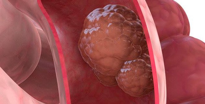 Polyp đại tràng và polyp dạ dày mà diễn viên Minh Tiệp vừa phát hiện có thể tiến triển thành ung thư không? - Ảnh 3. Polyp đại tràng và polyp dạ dày mà diễn viên Minh Tiệp vừa phát hiện có thể tiến triển thành ung thư không? - Ảnh 3.