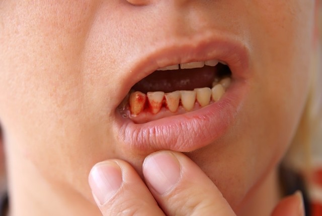 Người đàn ông bị nhiễm uốn ván sau khi xỉa răng: Hành động nhỏ nhưng rất nhiều người mắc - Ảnh 5.