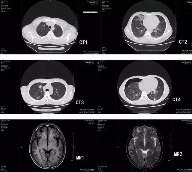 4 bệnh nhân Trung Quốc bị sán bò lúc nhúc ở phổi và não vì ăn 1 món ngon rất nhiều người không thể cưỡng nổi - Ảnh 2.