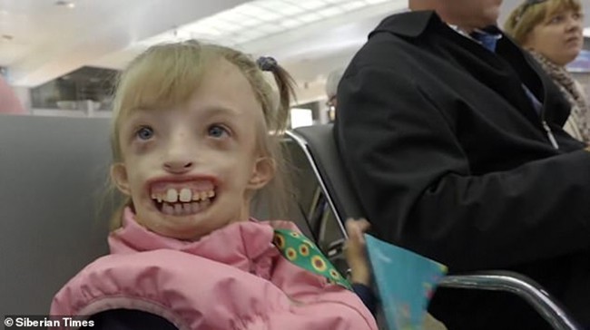 Thường khiến trẻ con sợ hãi với khuôn mặt bị mất một nửa, giờ đây bé gái 6 tuổi đã có thể nở nụ cười đầu tiên trong cuộc đời - Ảnh 1.