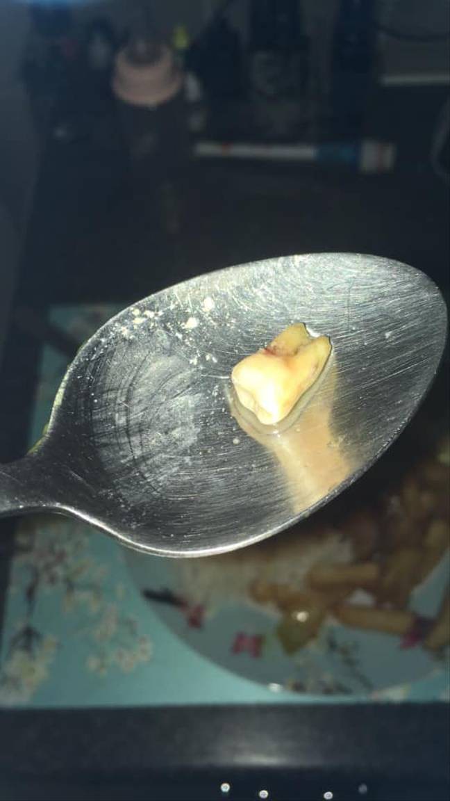 Cặp đôi đệ đơn kiện nhà hàng Trung Quốc vì tìm thấy nguyên chiếc răng sâu trong đồ ăn take-away - Ảnh 2.