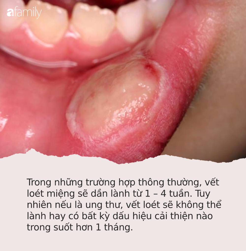 Có 4 dấu hiệu này khi loét miệng là bằng chứng cảnh báo ung thư đang phát triển trong cơ thể bạn - Ảnh 1.