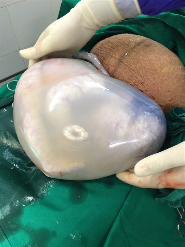 Hình ảnh 2 bé song sinh nằm trong túi ối hình trái tim khiến cư dân mạng kinh ngạc tột độ - Ảnh 1.
