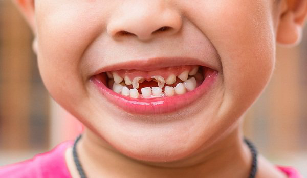 Cứ nghĩ sâu răng ở trẻ là bình thường, nhiều cha mẹ chủ quan không điều trị cho con để rồi dẫn đến biến chứng nguy hiểm thế này - Ảnh 3.
