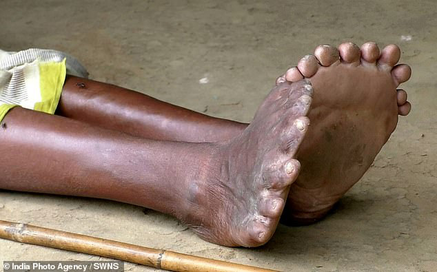 Người phụ nữ 63 tuổi sinh ra với 19 ngón chân và 12 ngón tay, cả đời bị dân làng xa lánh hắt hủi vì tưởng bà là phù thủy - Ảnh 4.