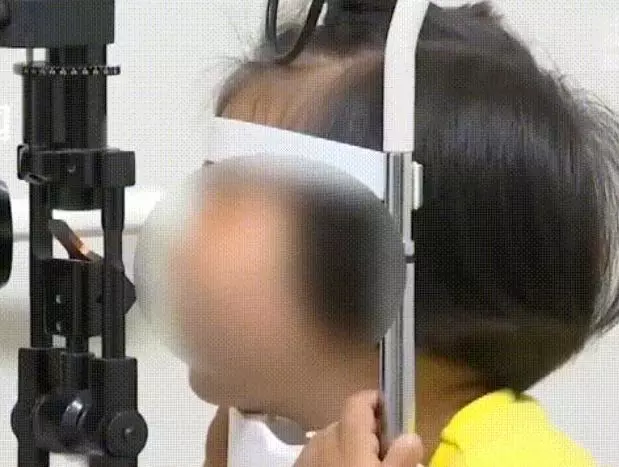 Con gái 5 tuổi khóc kêu ngứa mắt, người mẹ đưa con đến bệnh viện kiểm tra thì sợ hãi biết trong mắt bé có đến 20 con rận! - Ảnh 1.