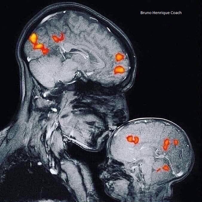 Hình ảnh chụp cộng hưởng từ MRI thật 100% chứng minh sự gắn kết ...