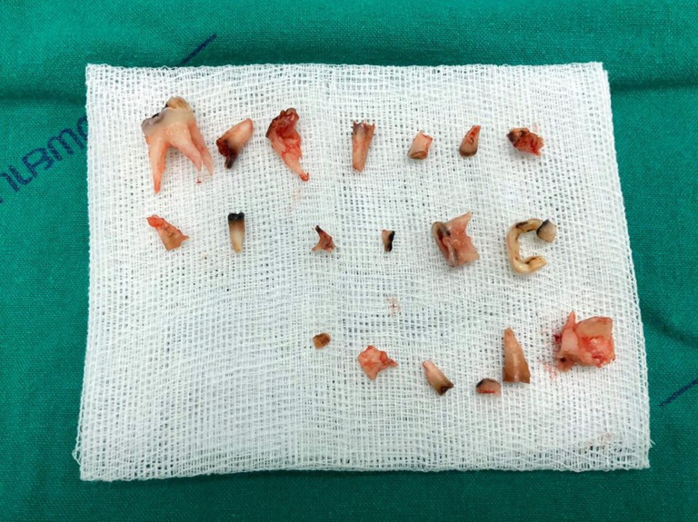 Mới có 4 tuổi nhưng một cậu bé đã phải phẫu thuật gây mê  nhổ 20 chiếc răng sữa bị sâu đến sát nướu - Ảnh 7.