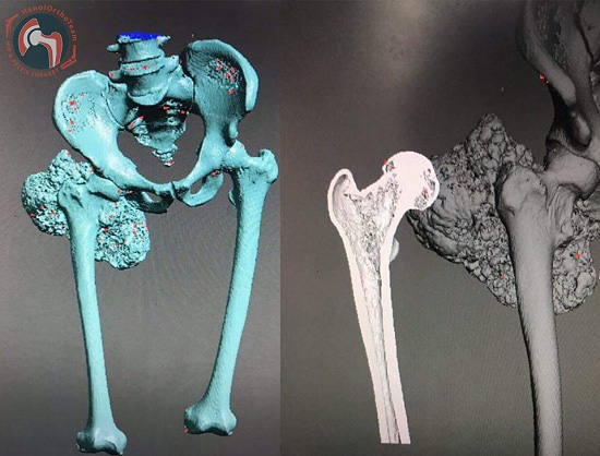 Lần đầu tiên tại Việt Nam ghép thành công xương đùi nhân tạo in 3D - Ảnh 1.