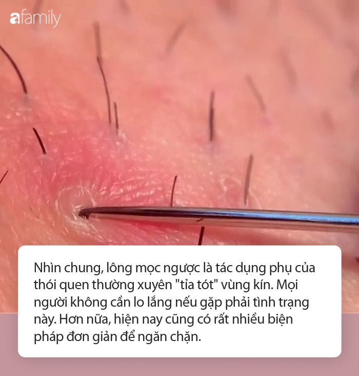 4. Phương pháp điều trị lông mọc ngược