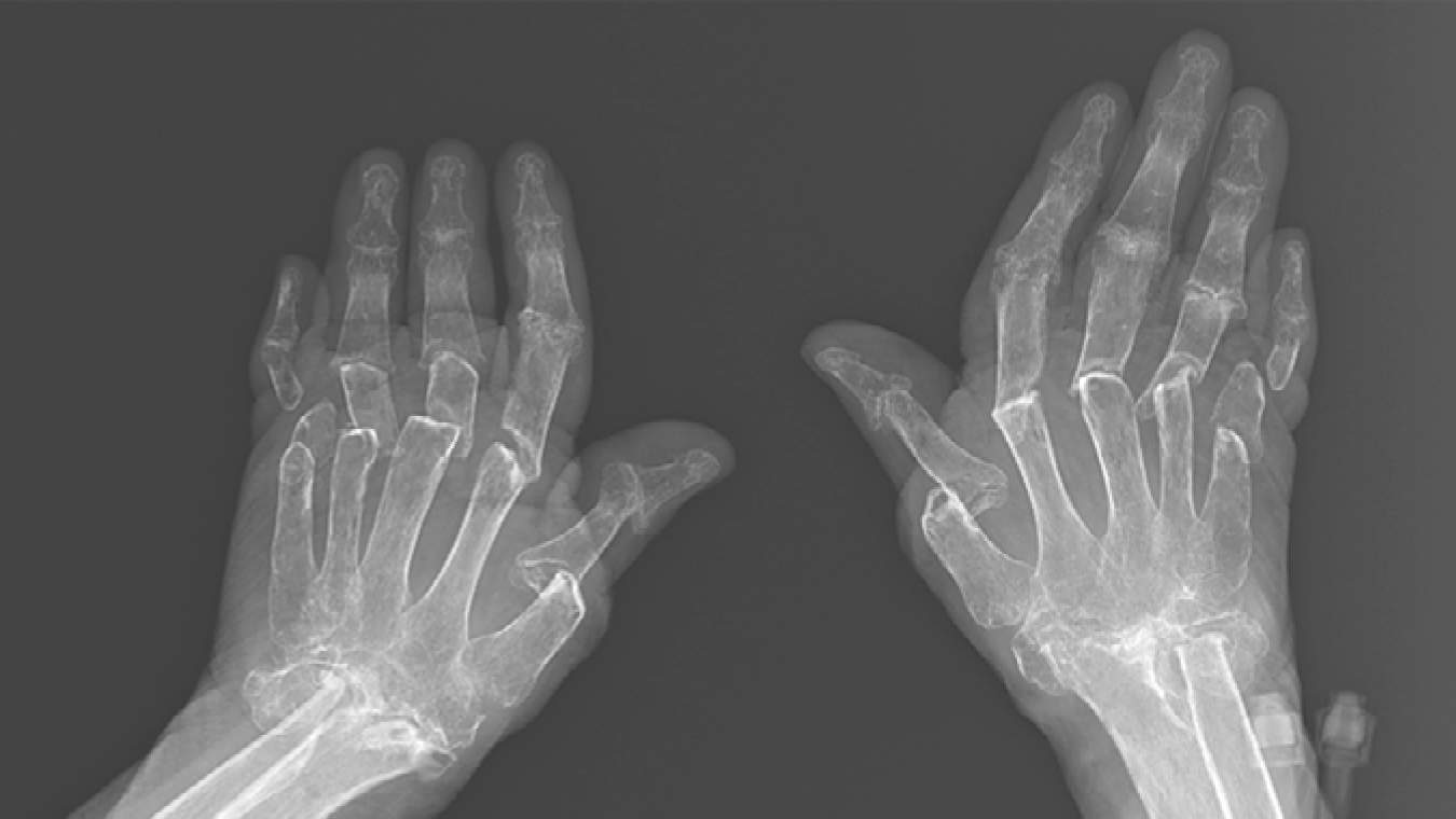 Chụp X-quang tiết lộ rõ thực tế bệnh nhân sống chung với bệnh viêm ...