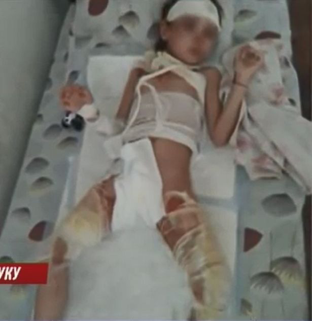 Chạy nhanh từ trong căn tin ra ngoài, bé gái 6 tuổi bỏng nặng khi bị một nồi súp đổ lên người - Ảnh 1.