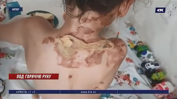 Chạy nhanh từ trong căn tin ra ngoài, bé gái 6 tuổi bỏng nặng khi bị một nồi súp đổ lên người - Ảnh 3.