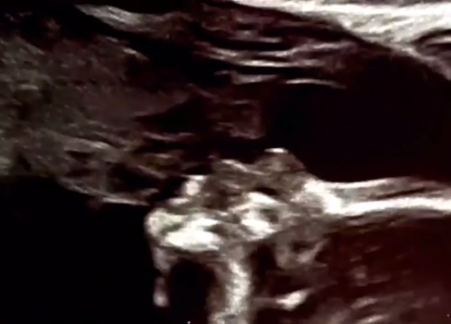 Siêu âm thai ở tuần 19, cả bố và mẹ đều tròn mắt ngạc nhiên khi bác sĩ chụp được ảnh này của con - Ảnh 4.