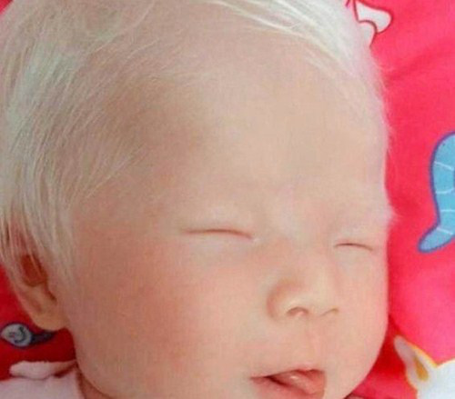 Em bé sinh ra tóc và lông mày đều trắng phau, bác sĩ tiết lộ nguyên nhân khiến cha mẹ bé bàng hoàng - Ảnh 2.