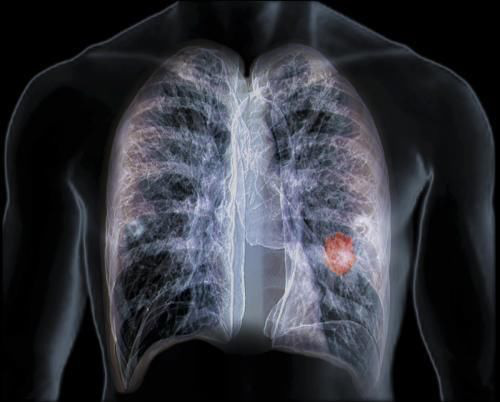 Tế bào ung thư phổi thường bị “kích thích” khi gặp 4 kiểu người này: Nếu có tên, bạn cũng nên đi khám sớm - Ảnh 2.