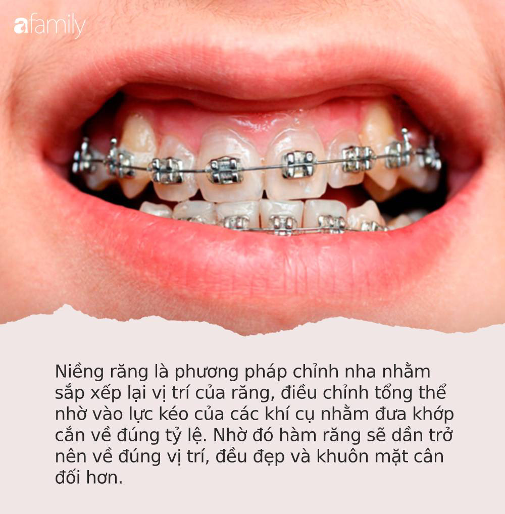Loạt sao chứng minh sức mạnh vi diệu của niềng răng và thời điểm vàng để bạn “cứu vãn” nhan sắc chỉnh nha - Ảnh 6.