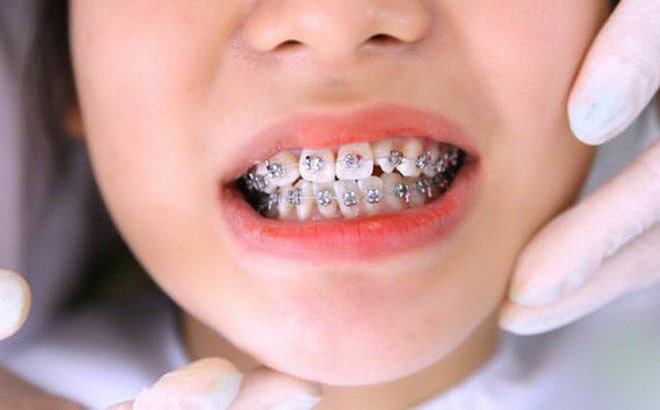 Loạt sao chứng minh sức mạnh vi diệu của niềng răng và thời điểm vàng để bạn “cứu vãn” nhan sắc chỉnh nha - Ảnh 8.