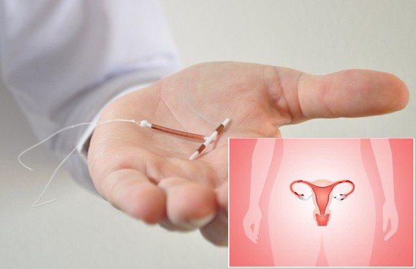 Sự cố vòng tránh thai: Vụ sự cố vòng tránh thai đi lạc trong cơ thể  - Ảnh 6.