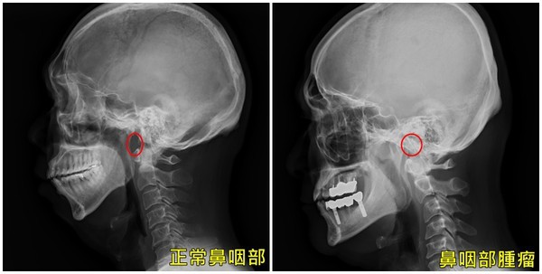 Người đàn ông bị nghẹt mũi, đêm ngủ ngáy, đi khám sốc khi phát hiện nguy hiểm - Ảnh 1.