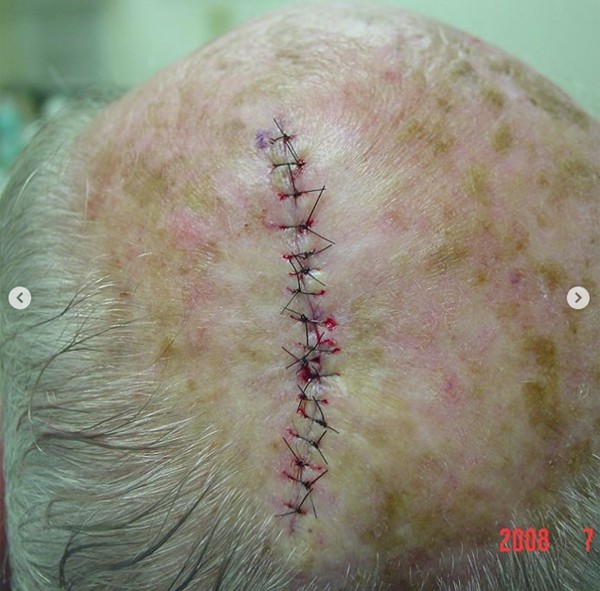 Chiếc lỗ đẫm máu trên đầu người đàn ông hóa ra lại là kết quả của việc điều trị ung thư da - Ảnh 2.