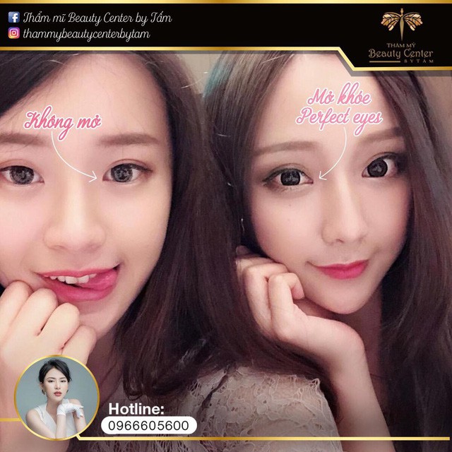 Sau filler, “mở góc mắt” chính là trào lưu làm đẹp mới của chị em - Ảnh 3. Sau filler, “mở góc mắt” chính là trào lưu làm đẹp mới của chị em - Ảnh 3.