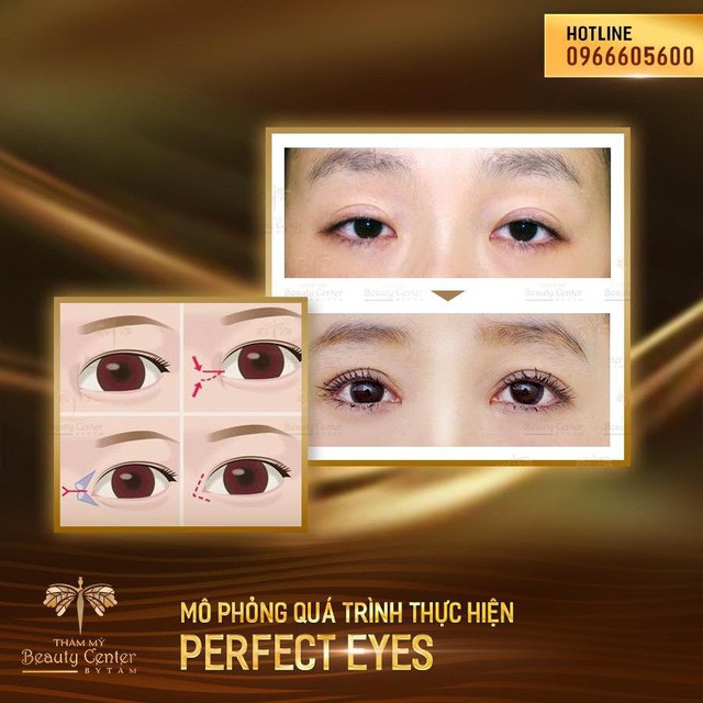 Sau filler, “mở góc mắt” chính là trào lưu làm đẹp mới của chị em - Ảnh 4. Sau filler, “mở góc mắt” chính là trào lưu làm đẹp mới của chị em - Ảnh 4.