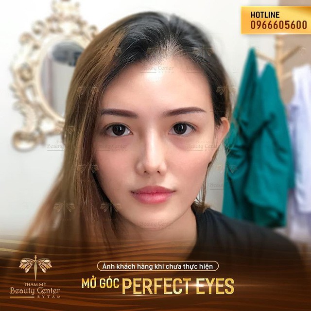 Sau filler, “mở góc mắt” chính là trào lưu làm đẹp mới của chị em - Ảnh 5. Sau filler, “mở góc mắt” chính là trào lưu làm đẹp mới của chị em - Ảnh 5.