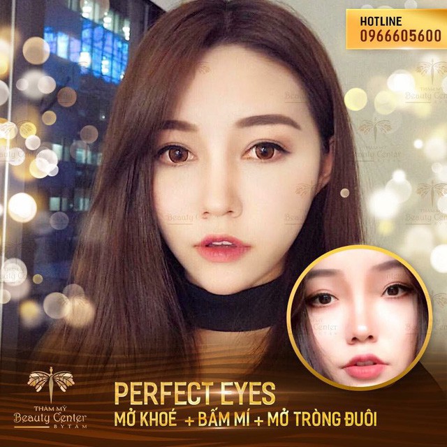Sau filler, “mở góc mắt” chính là trào lưu làm đẹp mới của chị em - Ảnh 6. Sau filler, “mở góc mắt” chính là trào lưu làm đẹp mới của chị em - Ảnh 6.