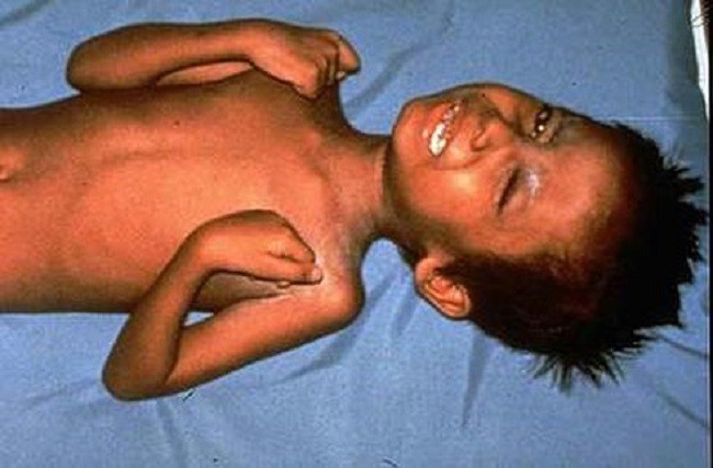 Trung tâm kiểm soát và phòng ngừa dịch bệnh Mỹ lên tiếng: Một cậu bé 6 tuổi suýt chết vì uốn ván do bố mẹ anti-vaccine - Ảnh 1.
