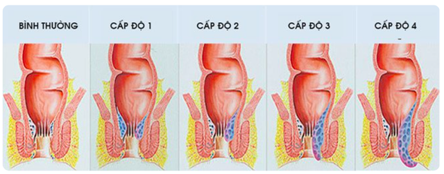 Hơn một nửa dân số mắc bệnh này, thường bắt đầu sau tuổi 30 - Ảnh 1.