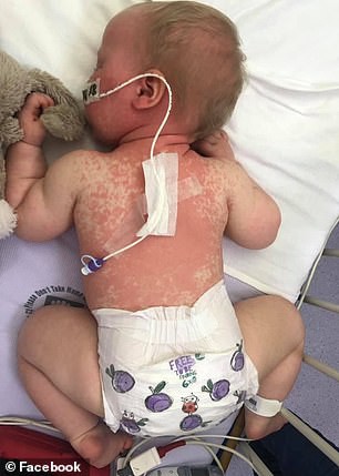 Con gái vật lộn gần như suýt chết vì mắc bệnh sởi, bà mẹ trẻ van nài các bậc cha mẹ khác đừng bao giờ quên làm điều này - Ảnh 5. Con gái vật lộn gần như suýt chết vì mắc bệnh sởi, bà mẹ trẻ van nài các bậc cha mẹ khác đừng bao giờ quên làm điều này - Ảnh 5.