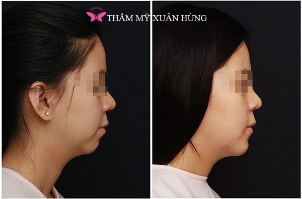 Tiêm Filler và những điều không phải ai cũng biết - Ảnh 1.