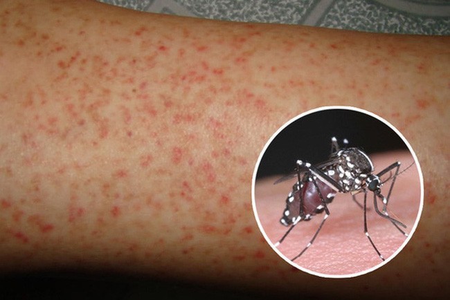 Nghĩ ngay đến mắc bệnh sốt xuất huyết nếu có những dấu hiệu này  - Ảnh 2.