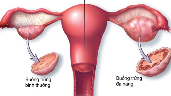 Ăn kiêng và tập thể dục có thể cải thiện hội chứng buồng trứng đa nang không? - Ảnh 3.