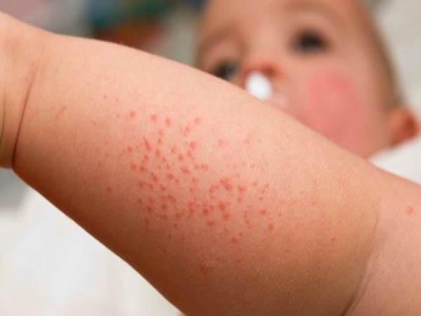 Chuyên gia cảnh báo: Cẩn trọng bệnh sốt xuất huyết đang có xu hướng tăng mạnh - Ảnh 3.