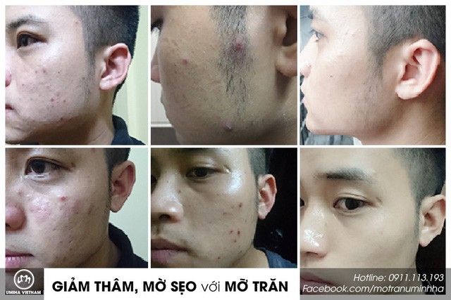Kh&aacute;m ph&aacute; những b&iacute; mật &iacute;t ai biết đến của mỡ trăn - Ảnh 2.