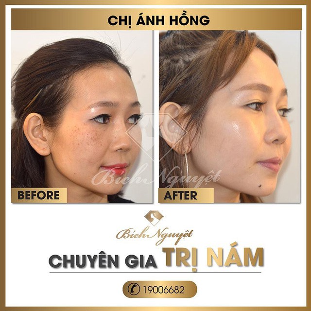 Hàng nghìn khách hàng trị nám thành công với “phác đồ Melas Ruby” - Ảnh 6. Hàng nghìn khách hàng trị nám thành công với “phác đồ Melas Ruby” - Ảnh 6.