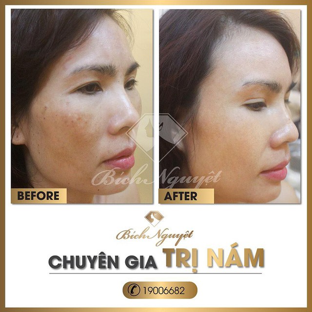 Hàng nghìn khách hàng trị nám thành công với “phác đồ Melas Ruby” - Ảnh 7. Hàng nghìn khách hàng trị nám thành công với “phác đồ Melas Ruby” - Ảnh 7.