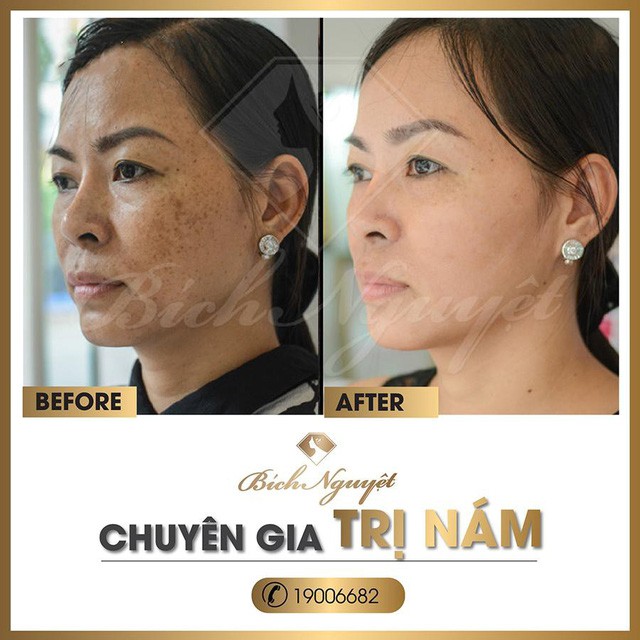 Hàng nghìn khách hàng trị nám thành công với “phác đồ Melas Ruby” - Ảnh 8. Hàng nghìn khách hàng trị nám thành công với “phác đồ Melas Ruby” - Ảnh 8.