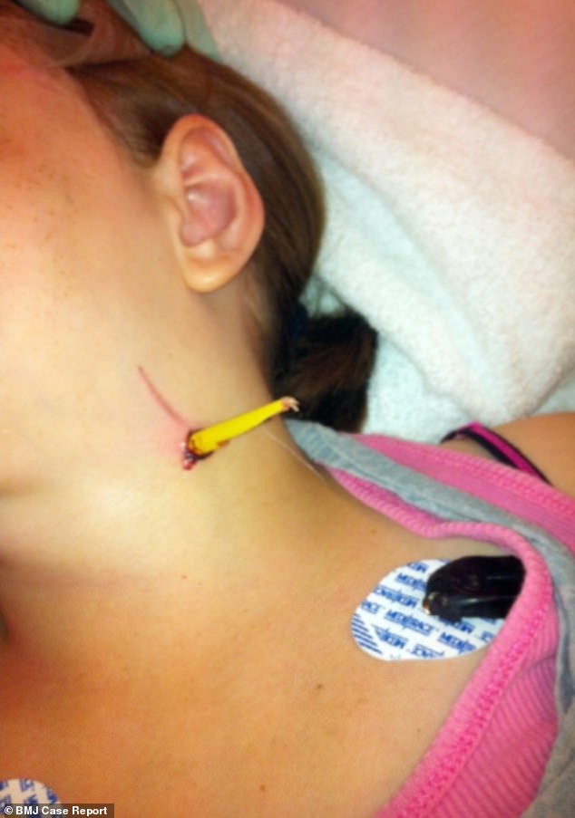 Bé gái 11 tuổi nhập viện khẩn cấp vì cây bút chì đâm sâu vào cổ nhưng dấu hiệu trên cổ bé mới khiến bác sĩ ngạc nhiên - Ảnh 2.