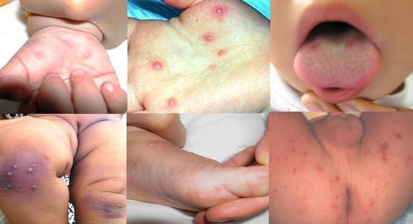 Trong 1 tuần có thêm 14 ca mắc tay chân miệng: Đây là dấu hiệu bệnh tay chân miệng và việc cha mẹ cần làm ngay để phòng bệnh cho con - Ảnh 2.
