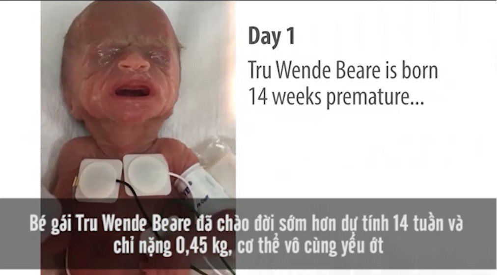 Em bé sinh non 14 tuần, nặng chưa đầy 0,5kg và hành trình sống sót kỳ diệu lấy đi nước mắt của hàng triệu người - Ảnh 2.