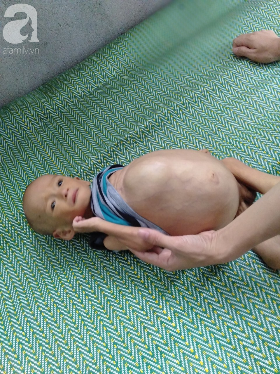 Sự sống mong manh của bé trai 1 tuổi, chỉ nặng 6kg, bụng phình to như cái trống mà mẹ nghèo không tiền chữa trị - Ảnh 9.